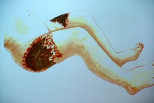 patologia Cecilia - emoraggie gambe