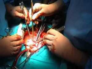 intervento chirurgo cuore